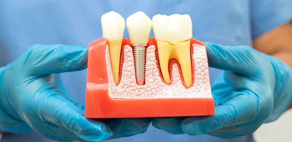 implantes-dentales-odonto-clinica-dental-doctor-javier-sanchez