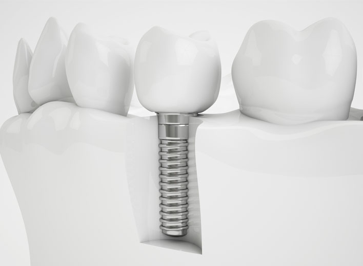 implantes-dentales-odonto-clinica-dental-doctor-javier-sanchez