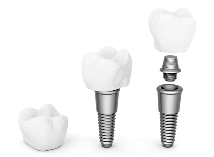 implantes-dentales-odonto-clinica-dental-doctor-javier-sanchez